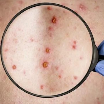 OMS: “Infecções de Monkeypox baixaram quase 90%, mas vírus continua a circular”