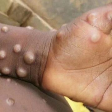  Malawi introduz rastreio obrigatório de Mpox 